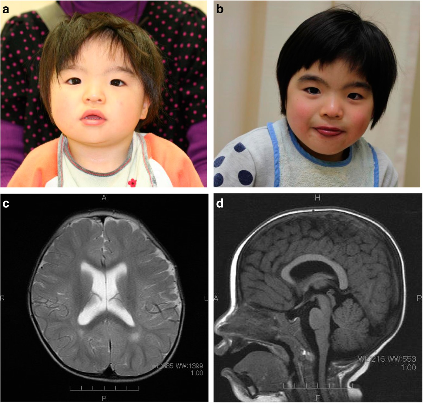 Rubinstein-Taybi syndrome  Radiology Reference Article