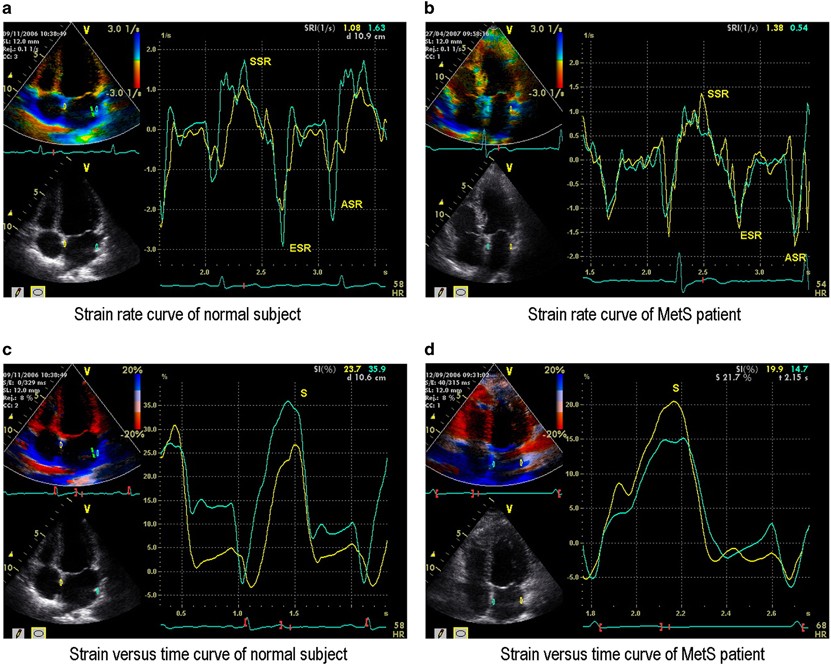 A systematic review and meta-analysis of the normal reference value of the  longitudinal left atrial strain by three dimensional speckle tracking  echocardiography