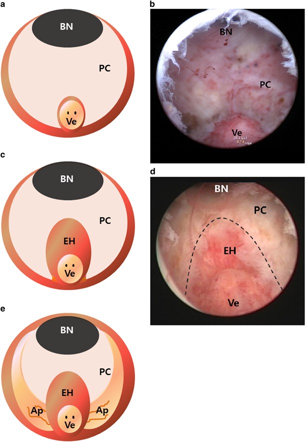 adenoma prostate operation laser