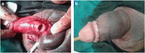 Comparison of different approaches to the surgical treatment of penile  fractures: quicker return to sexual function with longitudinal incisions |  International Journal of Impotence Research