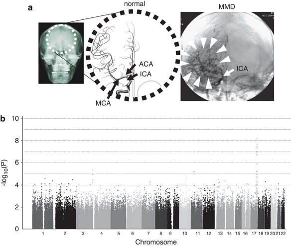 A Genome Wide Association Study Identifies Rnf213 As The First Moyamoya Disease Gene Journal Of Human Genetics