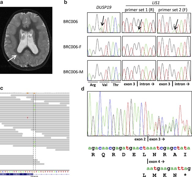 Exome Sequencing Can Detect Pathogenic Mosaic Mutations Present At Low Allele Frequencies Journal Of Human Genetics
