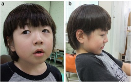 A Case Of Autism Spectrum Disorder Arising From A De Novo Missense Mutation In Pogz Journal Of Human Genetics A Case Of Autism Spectrum Disorder Arising From A De Novo Missense Mutation In Pogz Journal Of Human Genetics