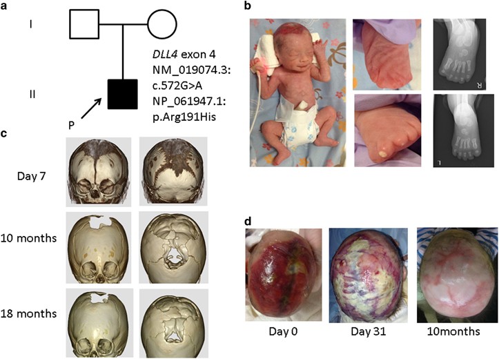 Identification of de novo EP300 and PLAU variants in a patient with  Rubinstein–Taybi syndrome-related arterial vasculopathy and skeletal  anomaly