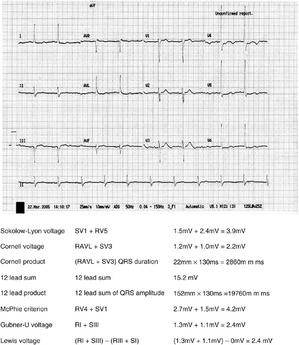 The prognostic value of the ECG in hypertension: where are we now? |  Journal of Human Hypertension