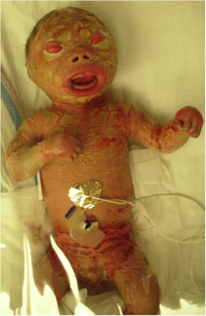 Perinatal Management Of Harlequin Ichthyosis A Case Report And Literature Review Journal Of Perinatology