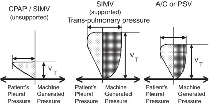 State of the art in conventional mechanical ventilation | Journal of  Perinatology