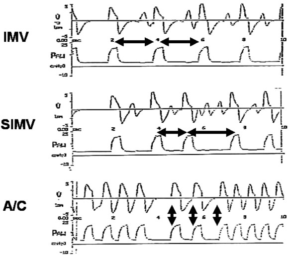 Neonatal ventilators: how do they differ? | Journal of Perinatology