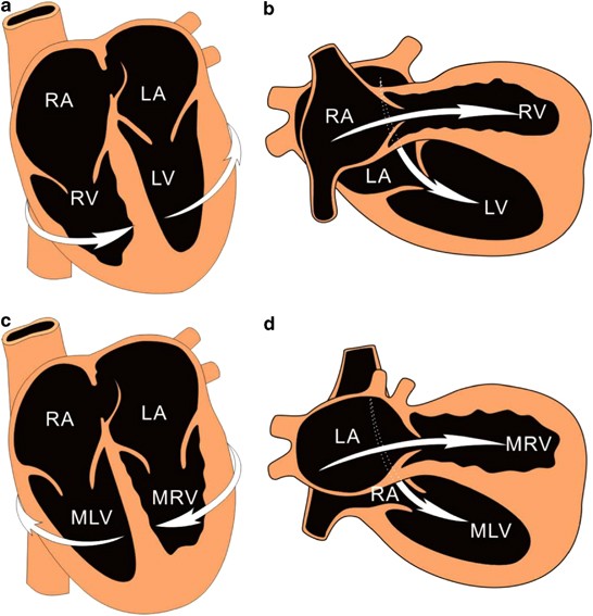 Prenatal diagnosis of criss-cross heart: sonographical and pathological  features of five cases