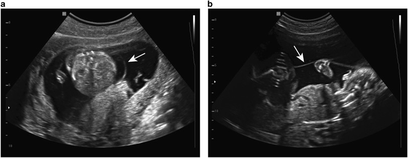 Beloved wireless Last Complete chorioamniotic membrane separation with constrictive amniotic band  sequence and partial extra-amniotic pregnancy: serial ultrasound  documentation and successful fetoscopic intervention | Journal of  Perinatology