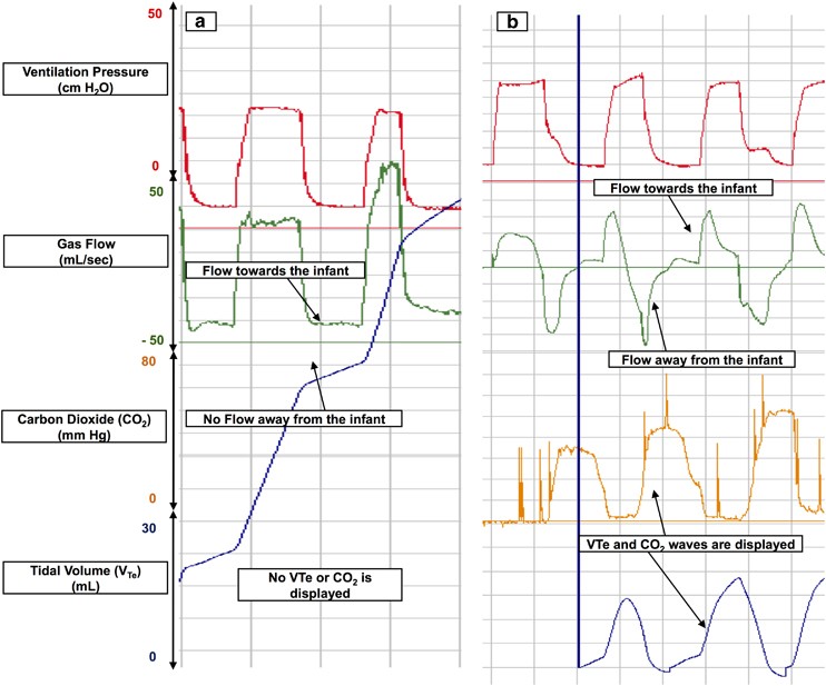 Neonatal Ett Size Chart