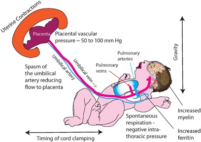 Placental transfusion: a review | Journal of Perinatology