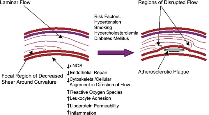 The role of shear stress in the pathogenesis of atherosclerosis