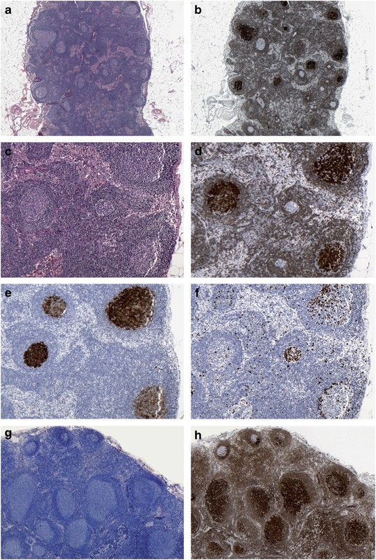 Increasing genomic and epigenomic complexity in the clonal