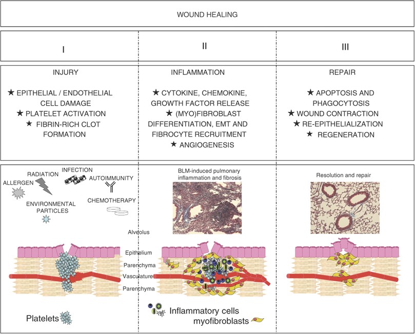 Pulmonary fibrosis: pathogenesis, etiology and regulation | Mucosal  Immunology