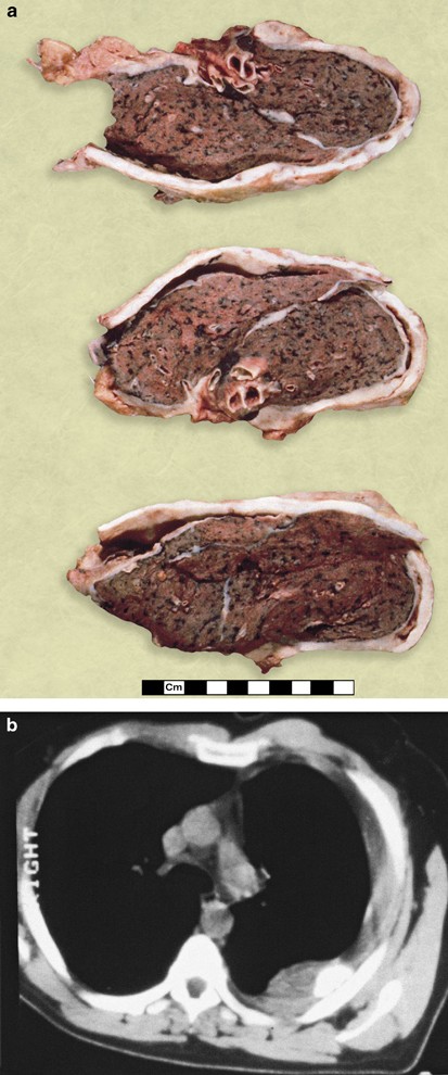 Sarcomatoid Mesothelioma A Clinical Pathologic Correlation Of 326 Cases Modern Pathology