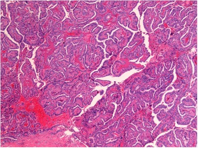 Papillary thyroid carcinoma: an update | Modern Pathology