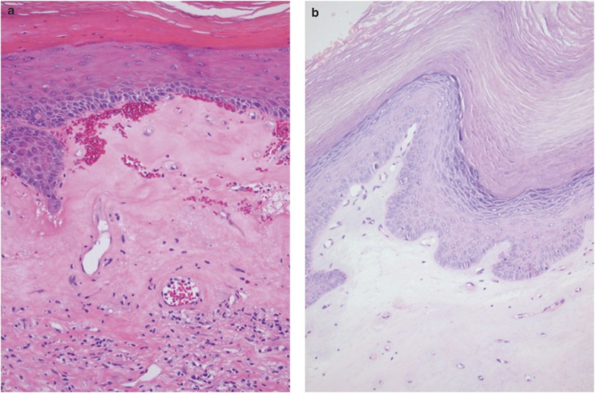Differentiated vulvar intraepithelial neoplasia is often found in lesions,  previously diagnosed as lichen sclerosus, which have progressed to vulvar  squamous cell carcinoma | Modern Pathology