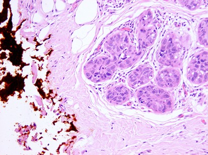 squamous cell carcinoma in situ histology