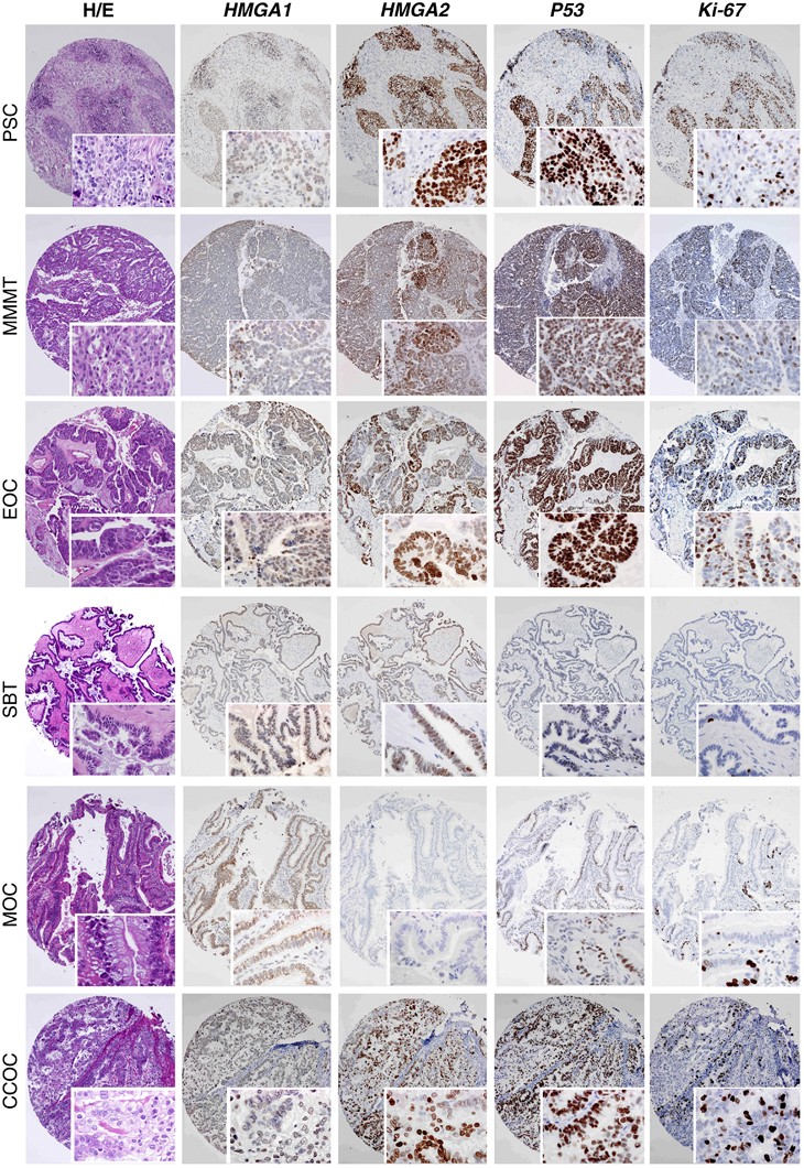 Modern Pathology - HMGA2: A biomarker significantly overexpressed in high-g...
