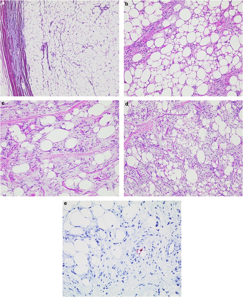 spindle cells and ropey collagen- found in spindle cell lipomas