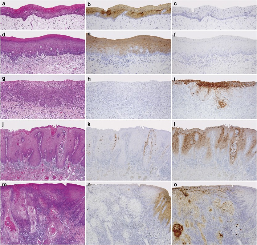 13+ Cavity Vs Stain Chart