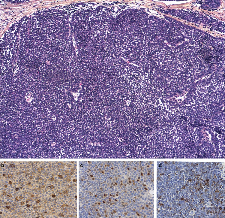 Foxo1 Fgfr1 Fusion And Amplification In A Solid Variant Of Alveolar Rhabdomyosarcoma Modern Pathology