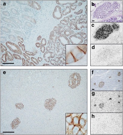 glp 1 thyroid nodules Glucagon-like-peptide-1 receptor expression in normal and diseased human  thyroid and pancreas