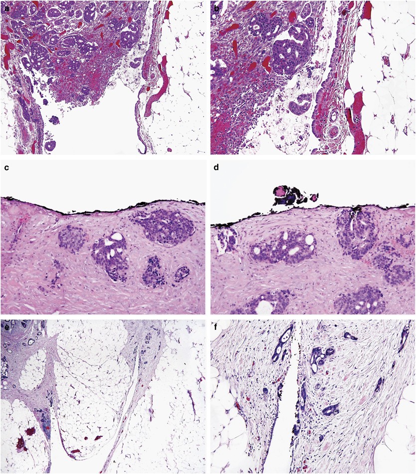Serosal surfaces, mucin pools, and deposits, Oh my: challenges in staging  colorectal carcinoma | Modern Pathology
