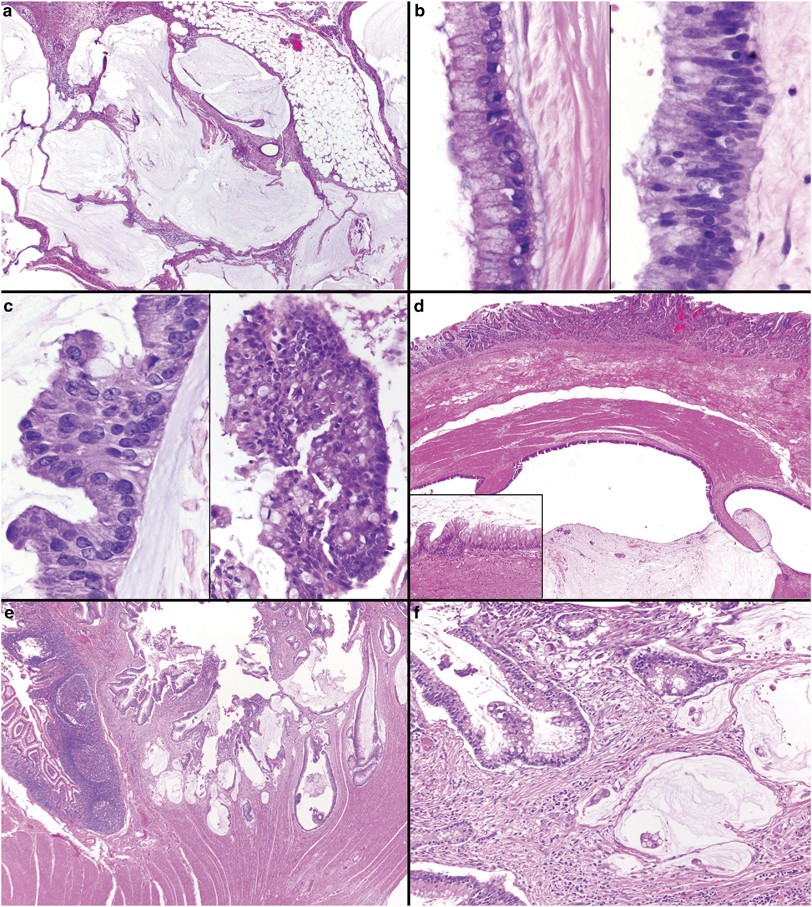 The Pathology of PMP and Appendix Tumours: A Primer for Non-Pathologists