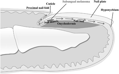 Histopathological analysis of the progression pattern of subungual  melanoma: late tendency of dermal invasion in the nail matrix area | Modern  Pathology