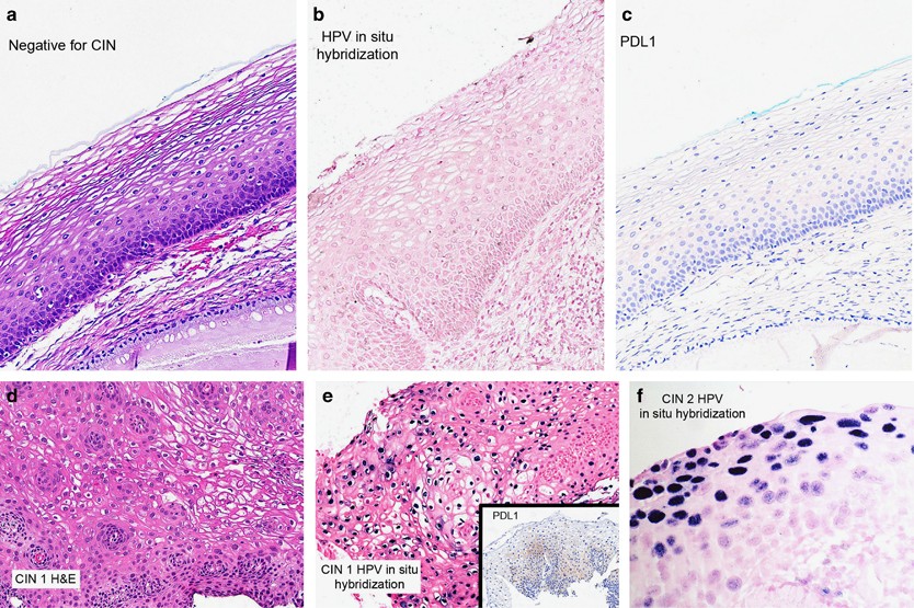 Enhanced expression of PD L1 in cervical intraepithelial neoplasia and  cervical cancers | Modern Pathology