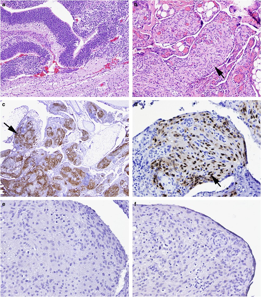 Gliomatosis Peritonei A Clinicopathologic And - 