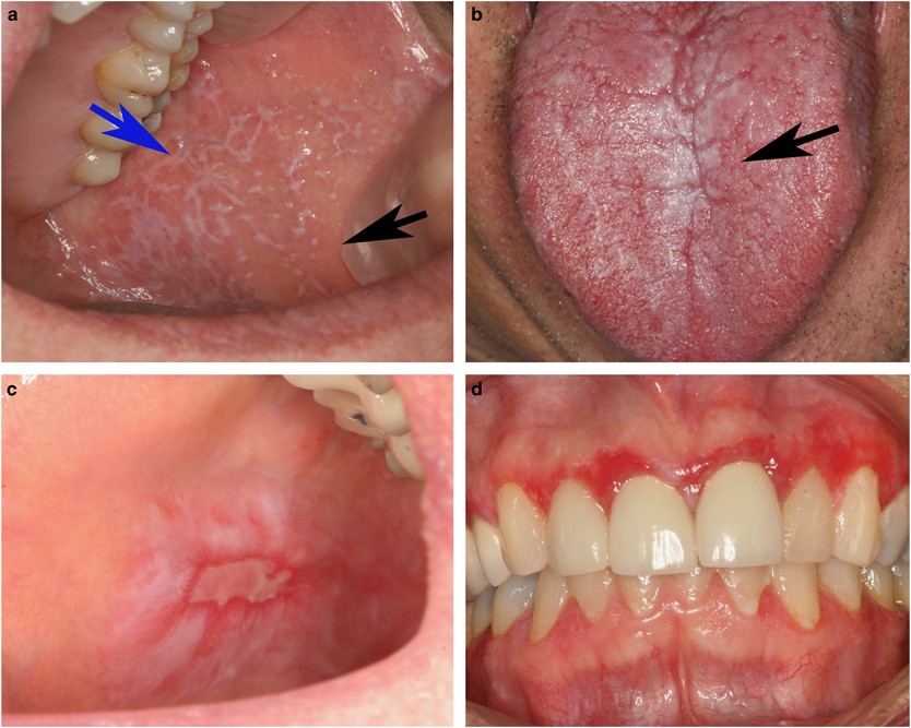 lesions: lichenoid Oral benign the from distinguishing the ...