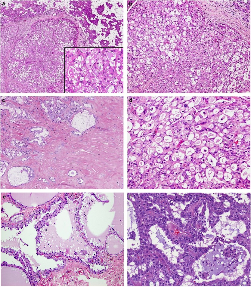 adenocarcinoma nos salivary gland pathology outlines)