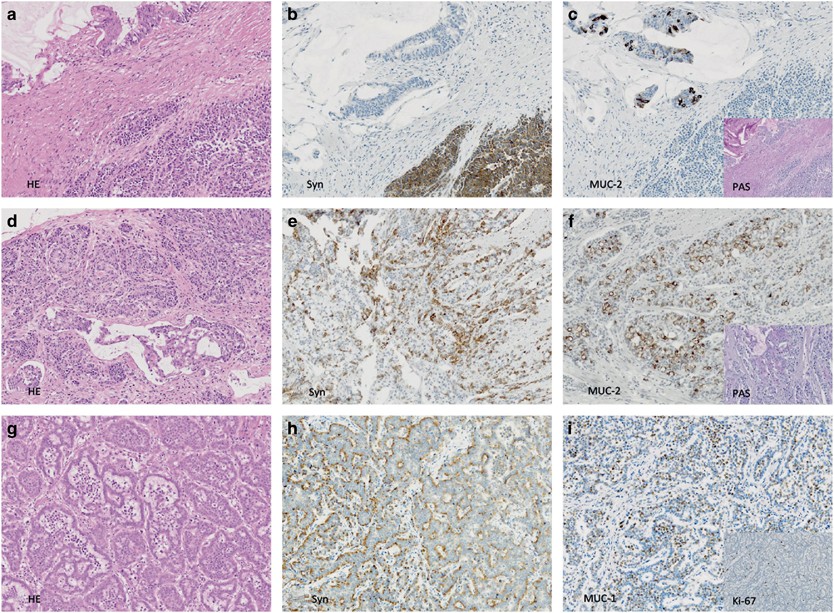 Colorectal mixed adenoneuroendocrine carcinomas and neuroendocrine  carcinomas are genetically closely related to colorectal adenocarcinomas |  Modern Pathology