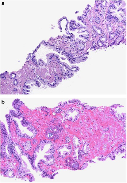 invasive prostatic adenocarcinoma acinar type