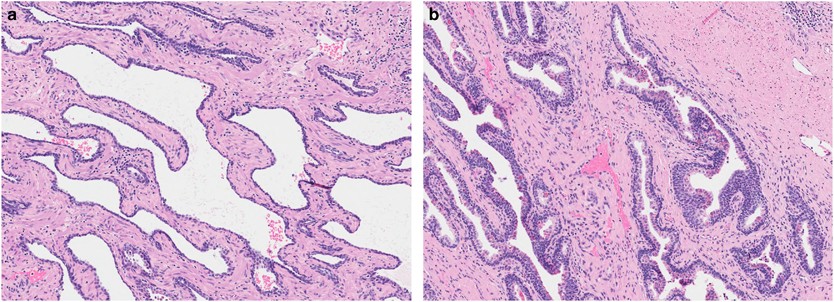 prostate cancer treatment effect histology krónikus prosztata nyomás