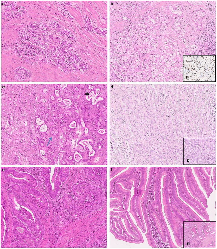 Goblet cell carcinoids of the appendix: Tumor biology, mutations and  management strategies