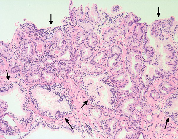 prostate adenocarcinoma)