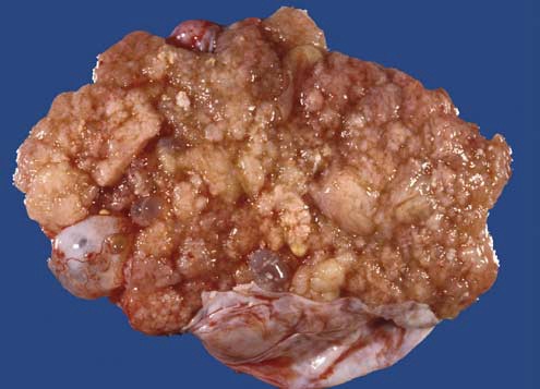 a Picture of an ovarian seromucinous borderline tumour. The