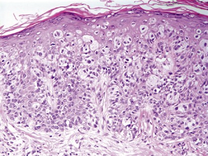 Histologic criteria for diagnosing primary cutaneous malignant melanoma |  Modern Pathology