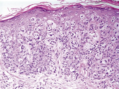 superficial spreading malignant melanoma