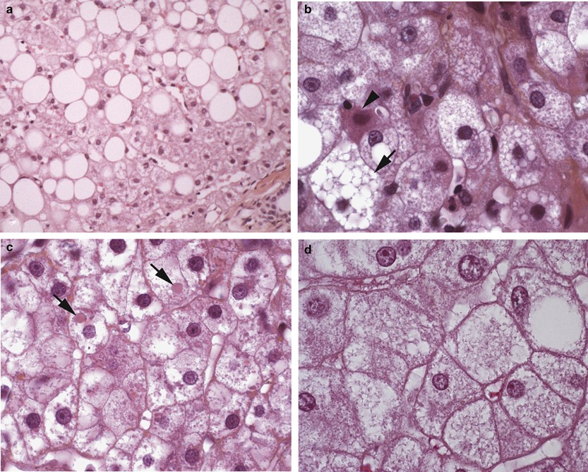Alteration of cytochrome oxidase subunit I labeling is associated with  severe mitochondriopathy in NRTI-related hepatotoxicity in HIV patients |  Modern Pathology