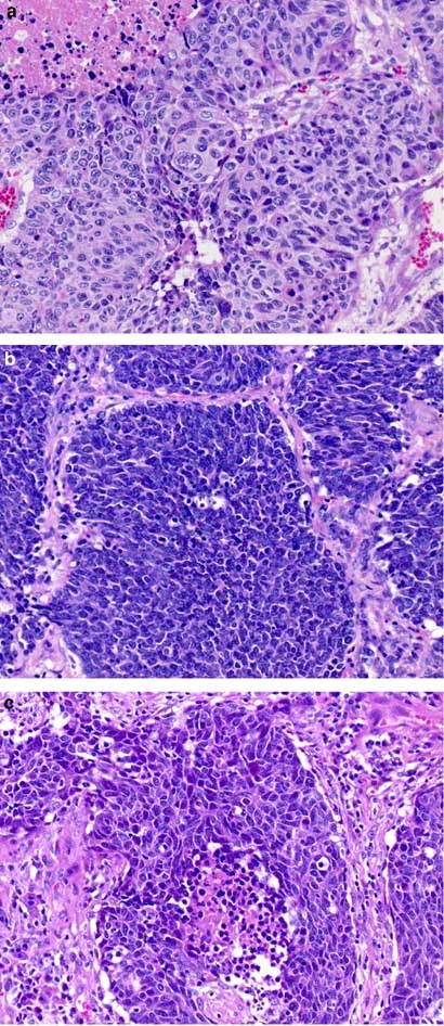 https://media.springernature.com/full/springer-static/image/art%3A10.1038%2Fmodpathol.3800659/MediaObjects/41379_2006_Article_BF3800659_Fig1_HTML.jpg