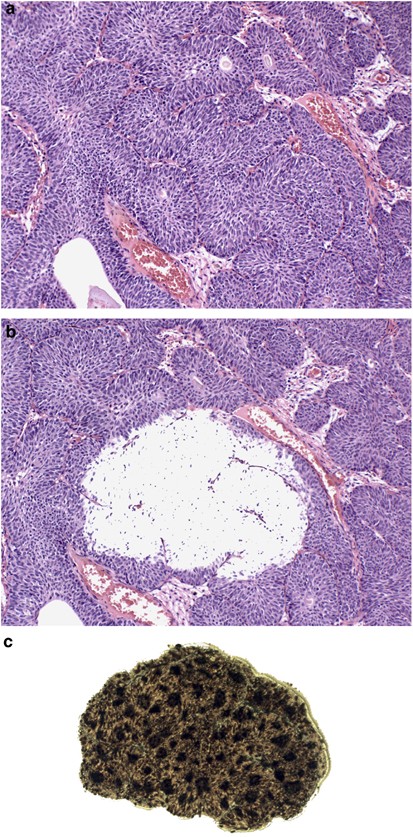 papilloma of the bladder