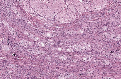 Chromosomal Gains In The Sarcomatoid Transformation Of Chromophobe Renal  Cell Carcinoma | Modern Pathology