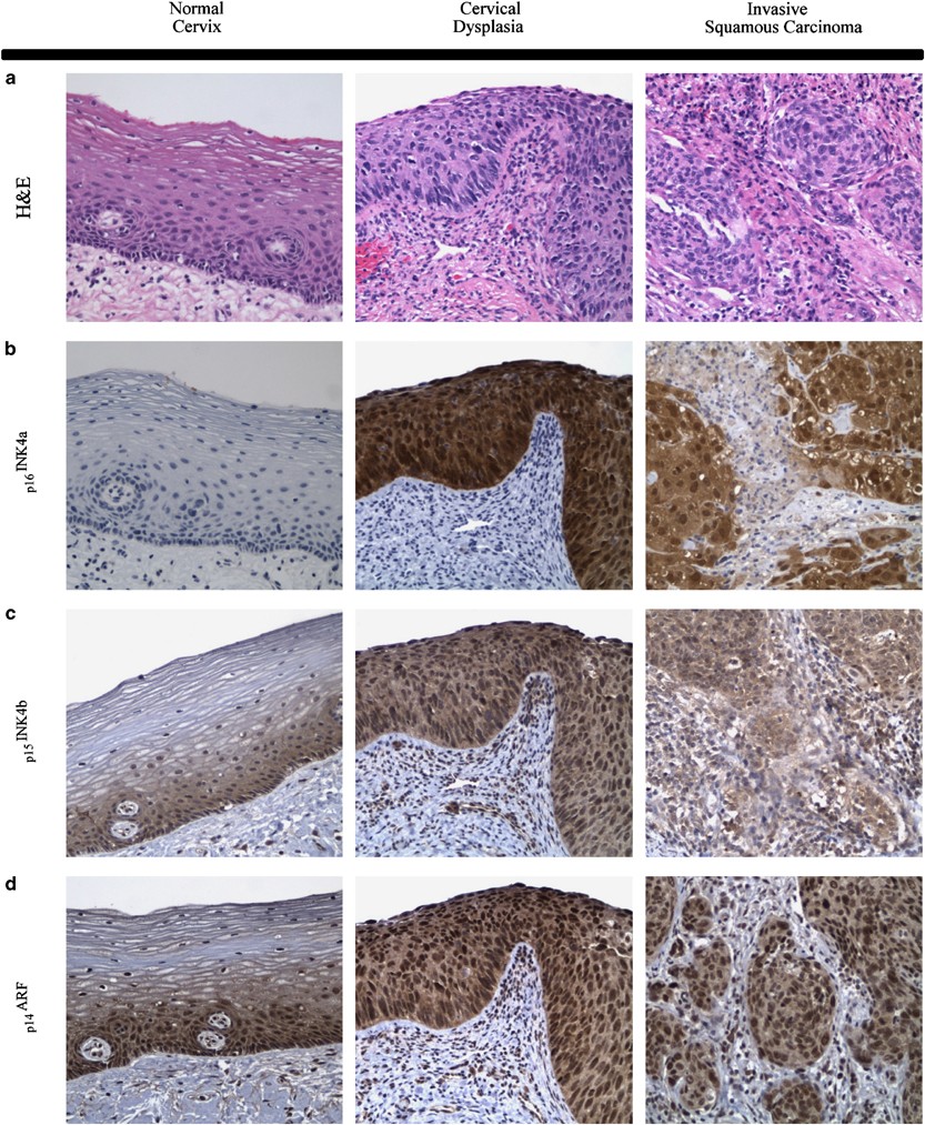 Senescence and apoptosis in carcinogenesis of cervical squamous carcinoma |  Modern Pathology