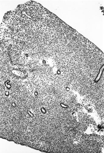 Noyes dating endometriumin biopsia