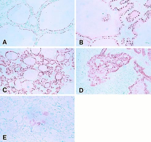 Thyroid Transcription Factor-1 in Normal, Hyperplastic, and Neoplastic  Follicular Thyroid Cells Examined by Immunohistochemistry and  Nonradioactive In Situ Hybridization | Modern Pathology